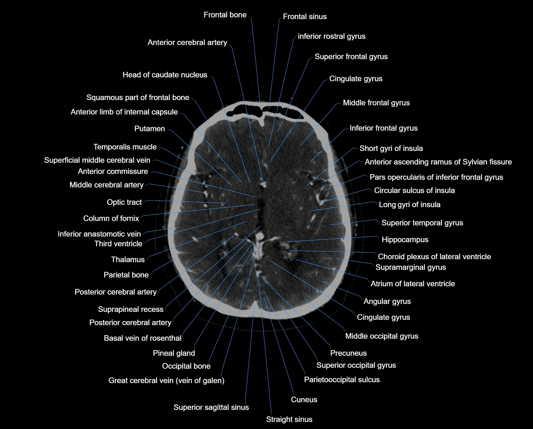 CT scan brain axial labelled cross sectional anatomy image-img-000034.webp